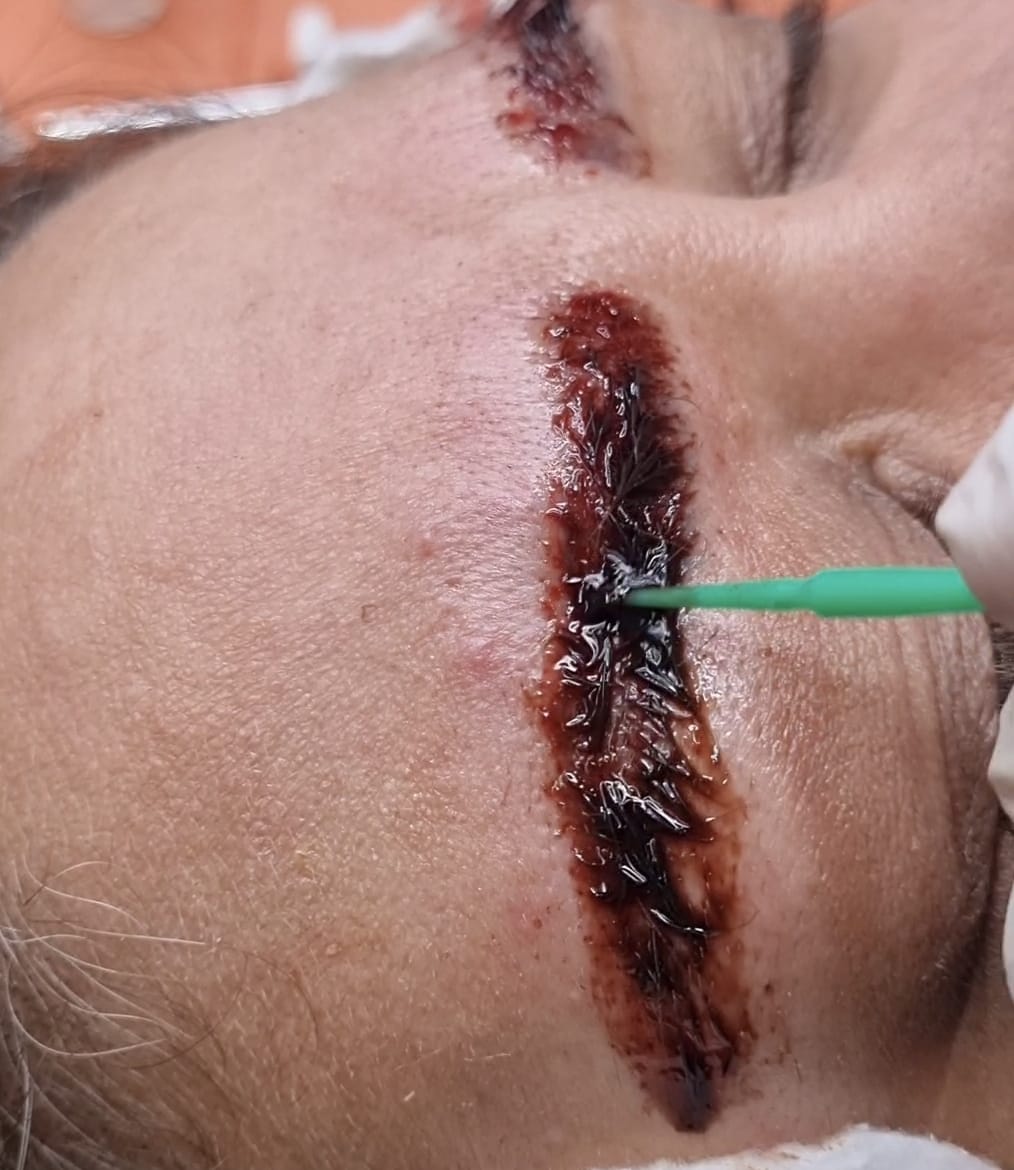 Tattoo Removal treatment